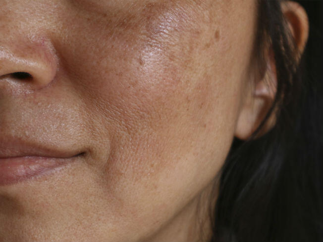 Qué es el melasma facial y cómo - Bulevar Sur